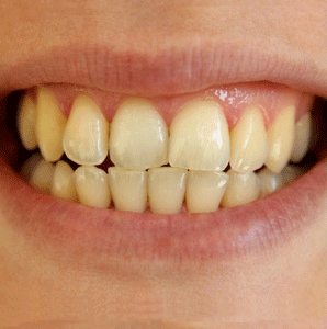 Resultado de imagen para gif dientes amarillos